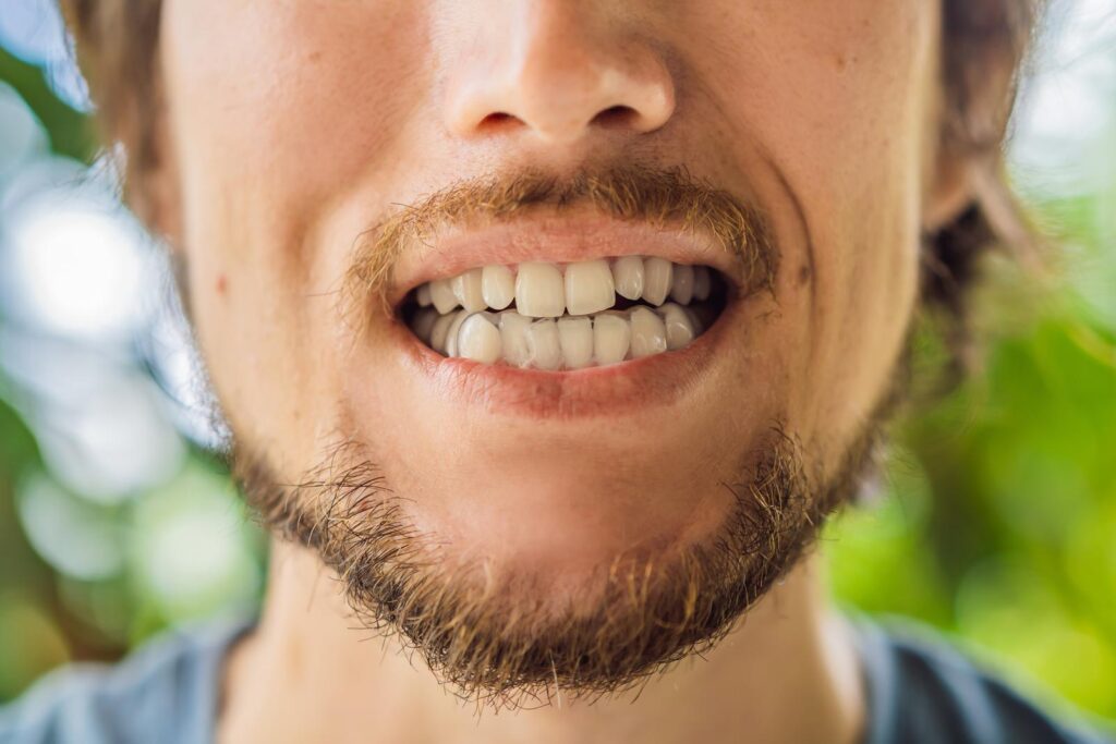 Open bite and Invisalign
