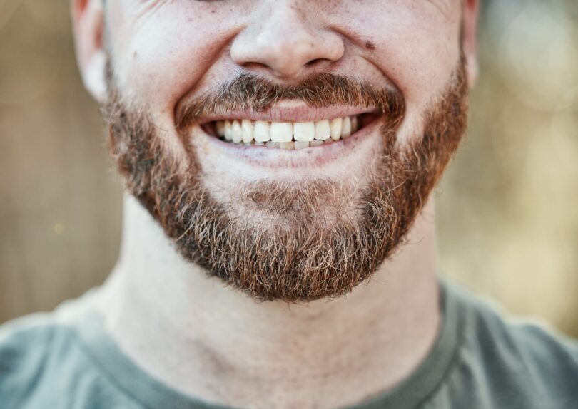 Dental veneers in York