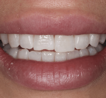 Smile Gallery