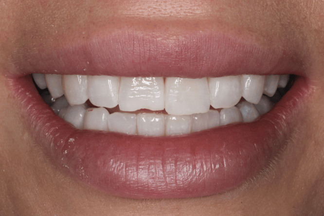 Before - York Dental