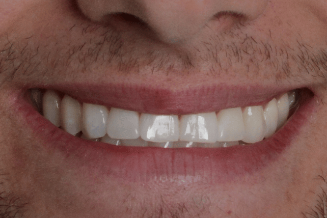 Before - York Dental