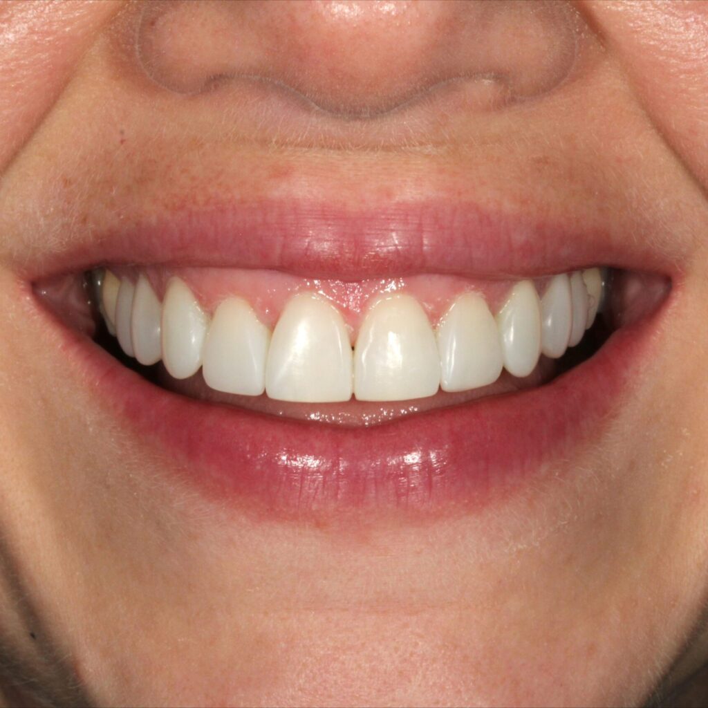 smile makeover in york