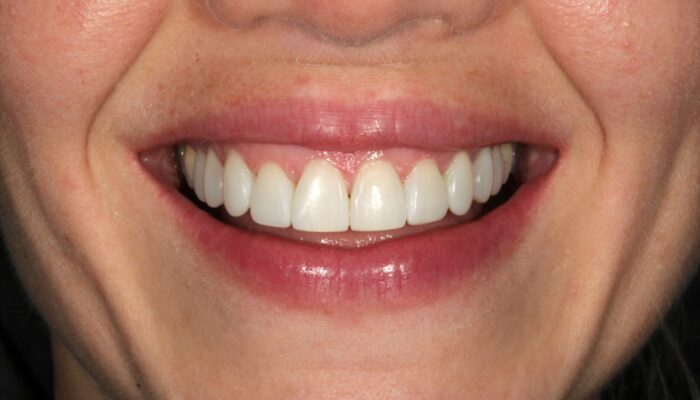 smile makeover in york